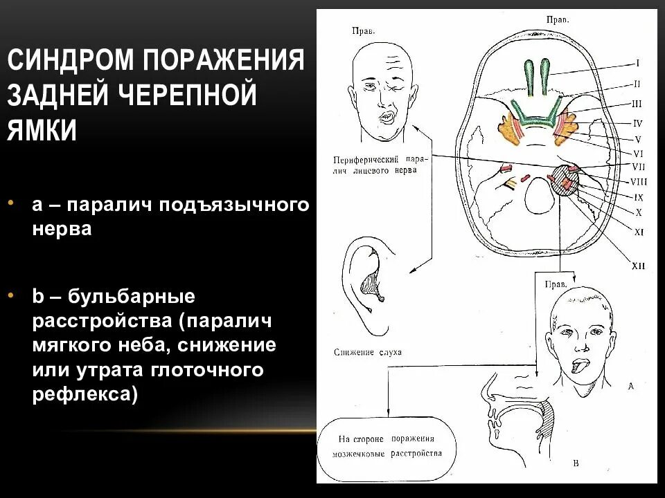 Поражение подъязычного нерва. Синдром патологии черепных нервов. Задняя черепная ямка головного мозга. Синдром задней черепной ямки. Синдромы поражения задней черепной ямки.