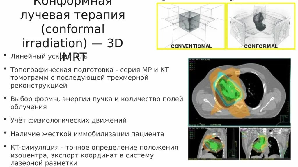 Конформная лучевая. Трехмерная конформная лучевая терапия. IMRT лучевая терапия. Конформная Дистанционная лучевая терапия это. Разметка для лучевой терапии.