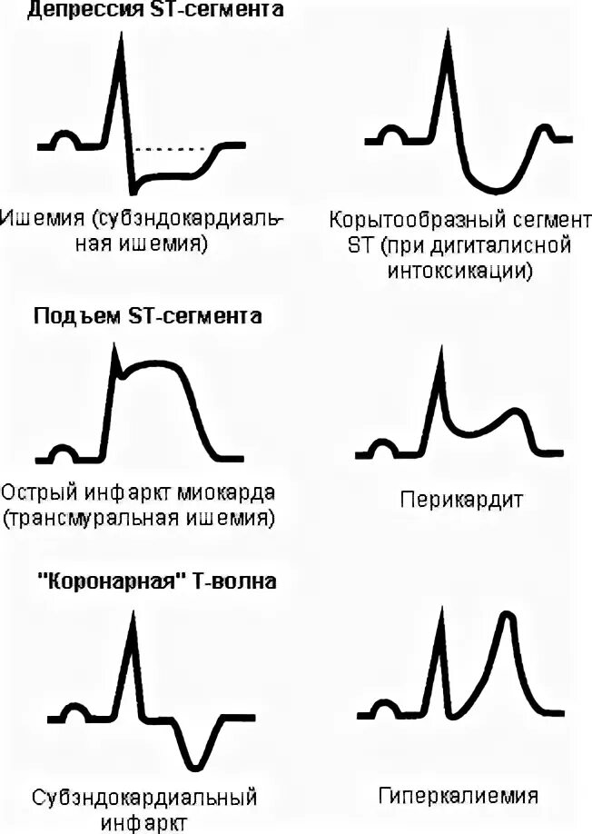 Депрессия сегмента st. ЭКГ инфаркт миокарда с подъемом St. Стадия ишемии инфаркта миокарда на ЭКГ. Острая ишемия миокарда на ЭКГ. St при инфаркте миокарда на ЭКГ.