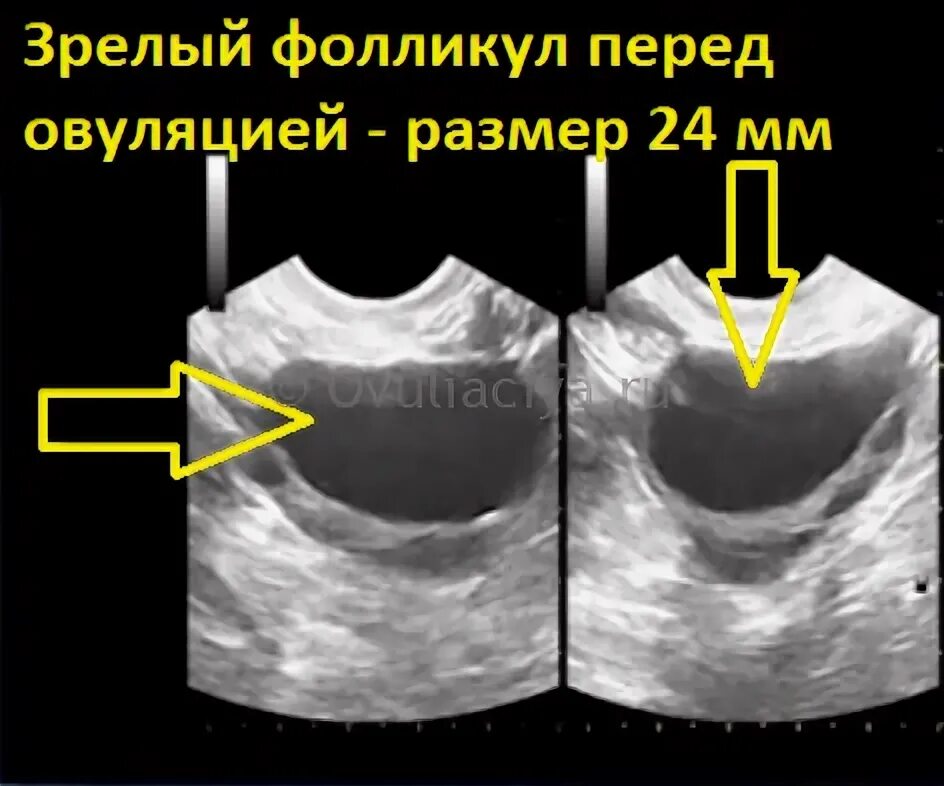 Какого размера должны быть фолликулы. УЗИ яичников по дням цикла. Фолликулярная киста яичника на УЗИ. Доминантный фолликул на УЗИ.