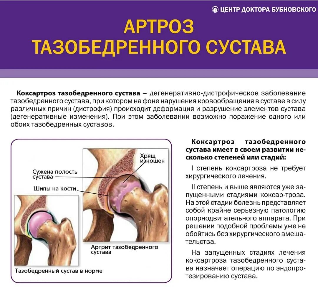 Тазобедренный сустав симптомы болезни. Артрит коксартроз тазобедренного. артрит бедренного сустава симптомы. коксартроз тазобедренного сустава симптомы. коксартроз клинические симптомы.