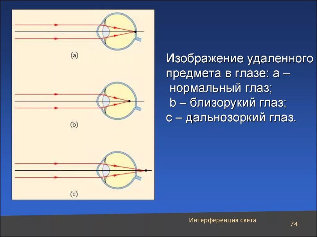 Дополните предложения изображение в близоруком