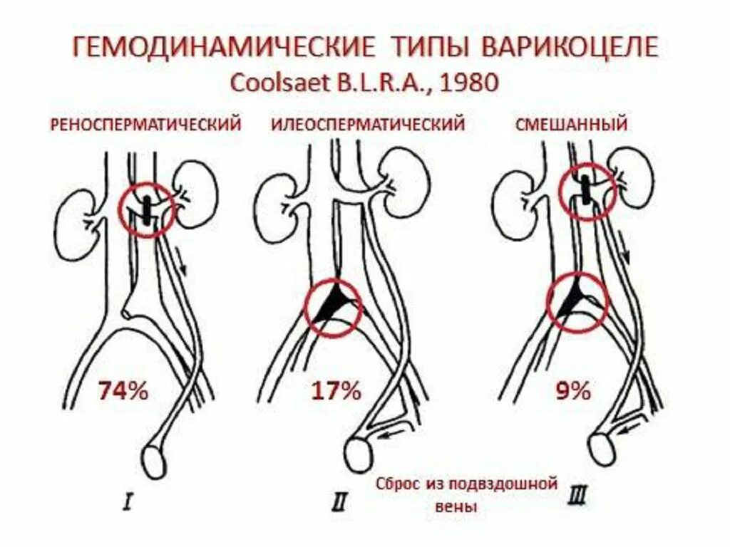 Гемодинамические типы варикоцеле по Coolsaet. Гемодинамическая классификация варикоцеле. Варикоцеле этапы операции. Варикоцеле классификация по степеням. Боли в области яичек