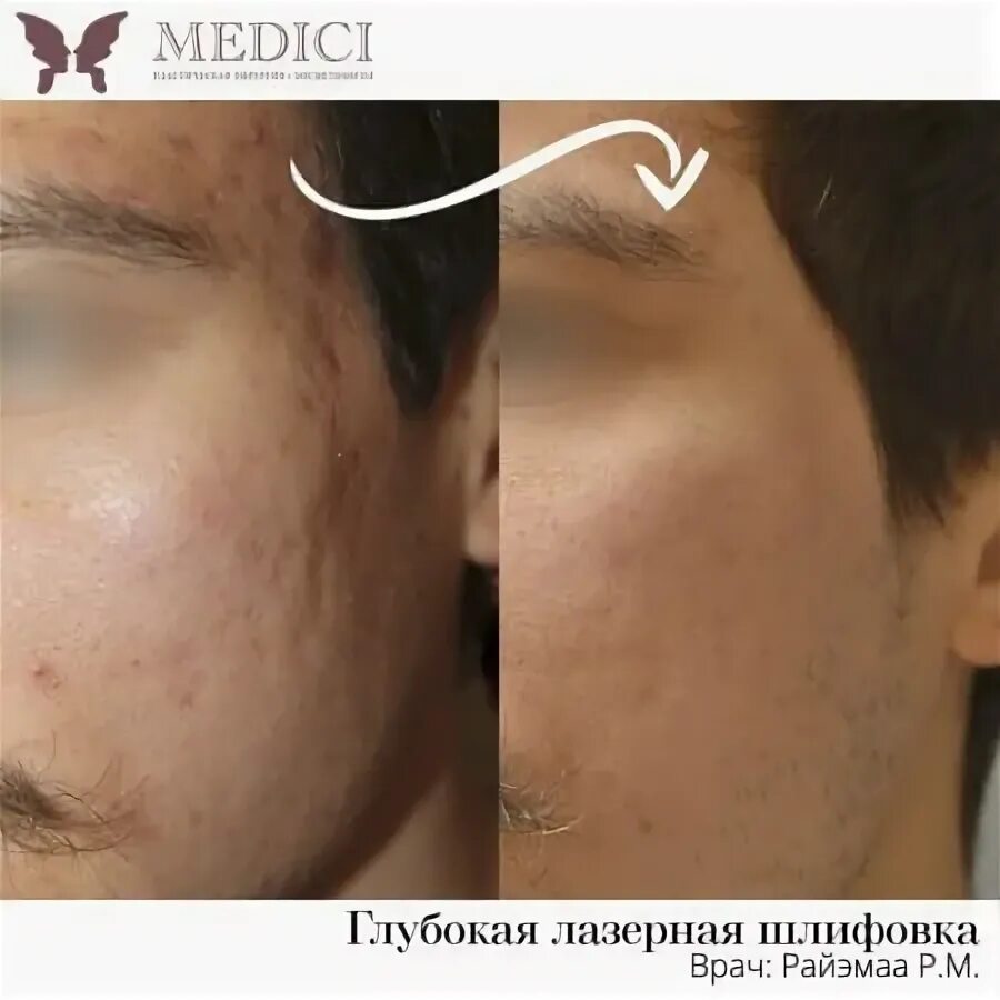 Со скольки лет можно делать лазерную