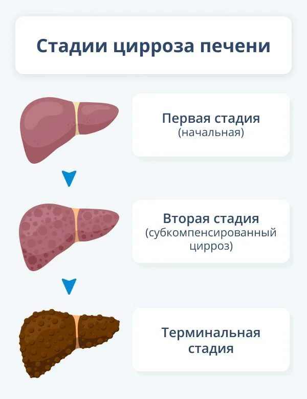 Цирроз печени тесты с ответами. Проявления цирроза печени. Начальная стадия цирроза печени.