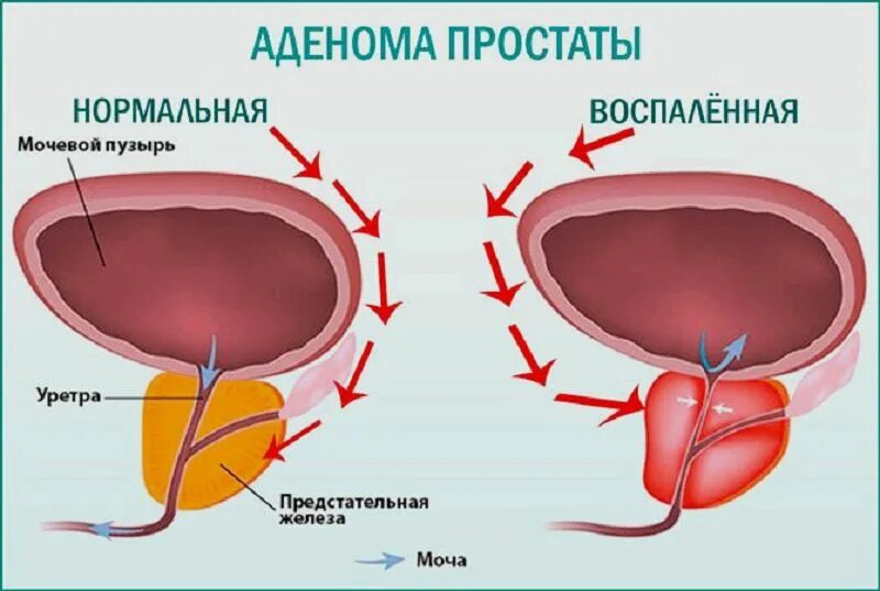 Простата 1