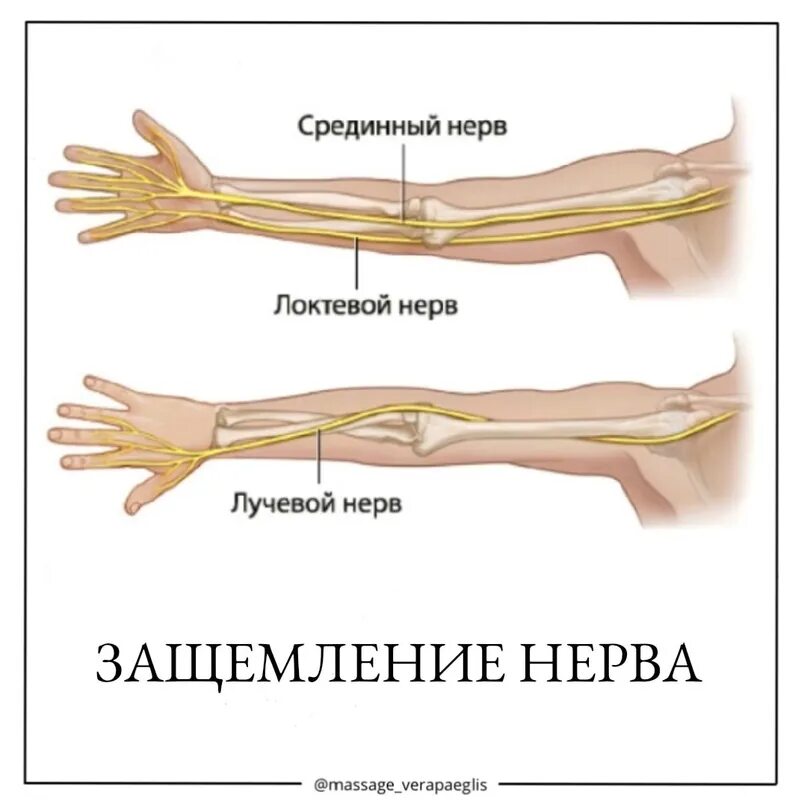 Тейпирование лучевого нерва. Защемление лучевого нерва в кисти. Защемление в правой руке. Защемление в правой руке. Лучевой нерв локтевой сустав.