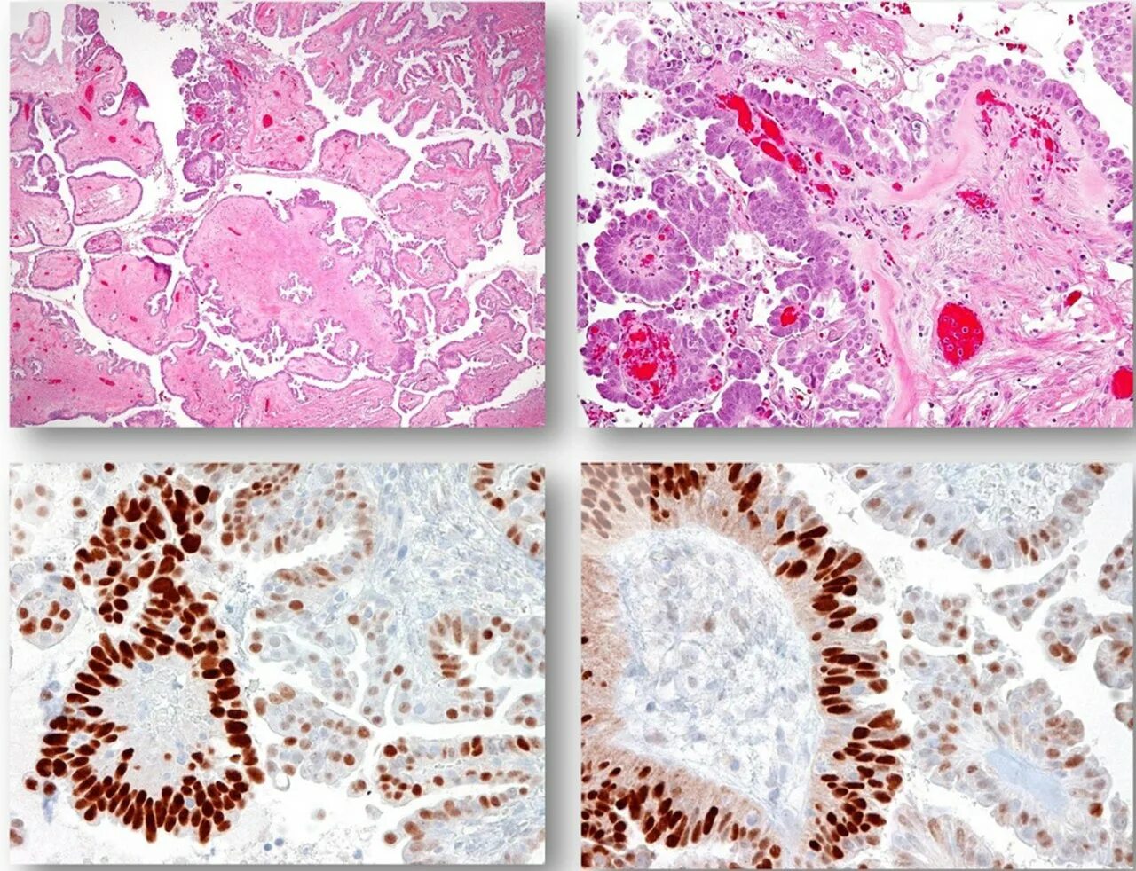 Экспрессия p53 гистология. Серозная аденокарцинома яичника High Grade. Серозная карцинома высокой степени. Что такое серозная карцинома высокой степени злокачественности. Серозная пограничная опухоль
