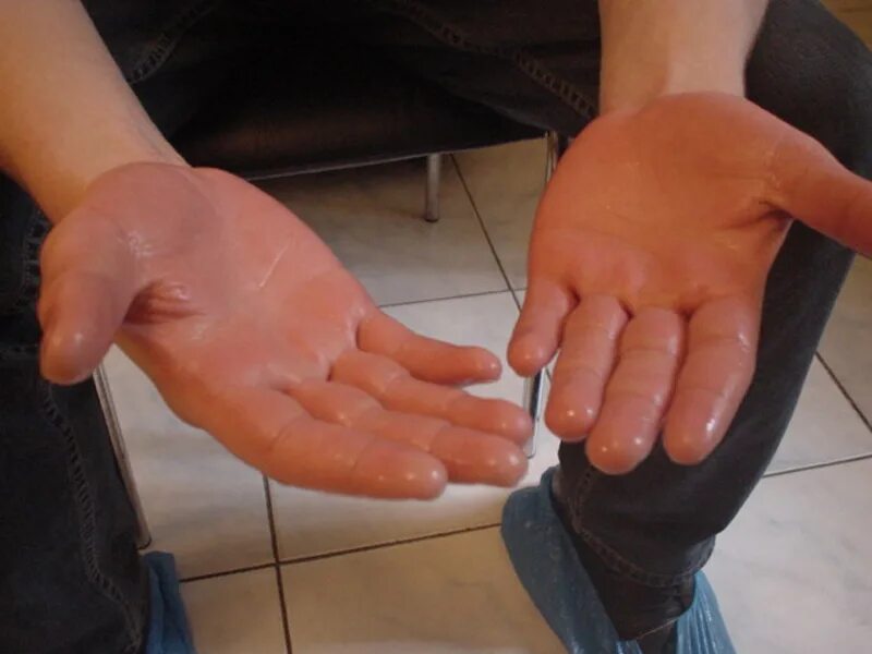 Акроцианоз синдром рейно. Холодные конечности рук. Холодные руки и ноги причины. Почему руки и ноги холодные. Мерзнут ноги.