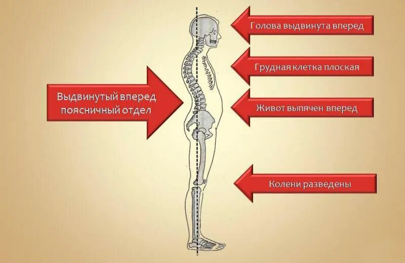 Лордоз поясничного отдела позвоночника. Лордоз поясничного отдела позвоночника симптомы. Лордоз грудного отдела позвоночника. Вторичный лордоз поясничного отдела. Прямой позвоночник без изгибов