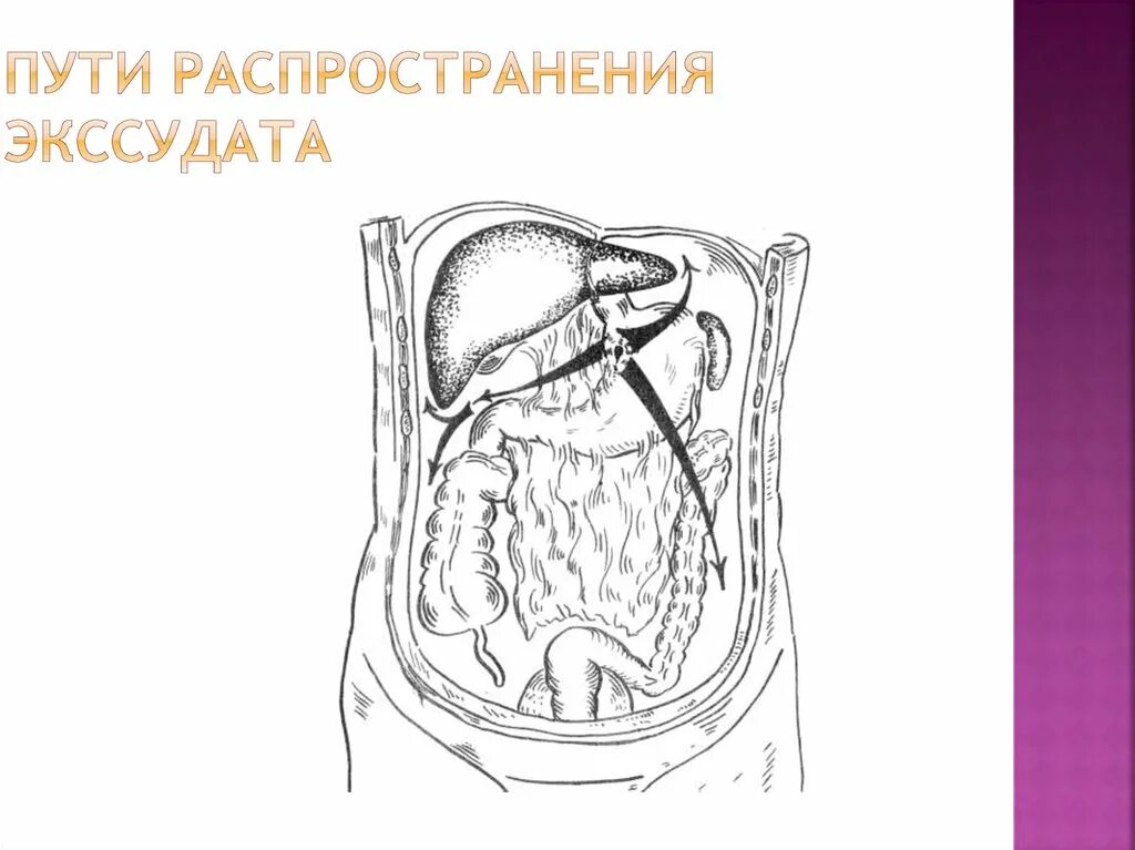 Пути распространения экссудата в брюшной полости. Распространение гноя в брюшной полости. Экссудат в брюшной полости. Пути распространения гноя по брюшной полости. Наличие гноя в брюшной полости