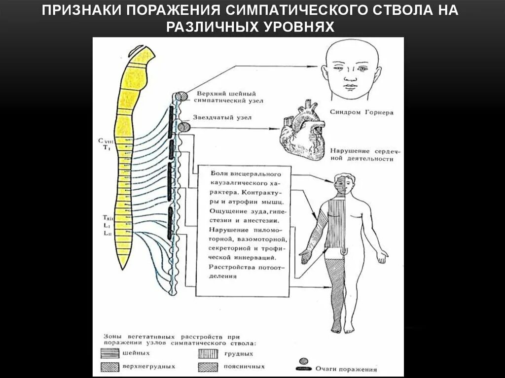 Звездчатый узел симпатического ствола поражение. Синдром поражения симпатических узлов. Шейные узлы симпатического ствола. Симптомы поражения симпатического ствола.