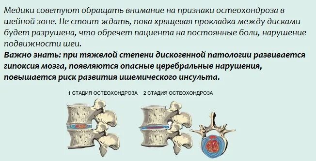 Остеохондроз шейно грудного отдела 2 степени. Остеохондроз 1-2 степени шейного отдела. Остеохондроз шейного отдела 2 степени симптомы. Остеохондроз шейного отдела 1 степени 2 степени.