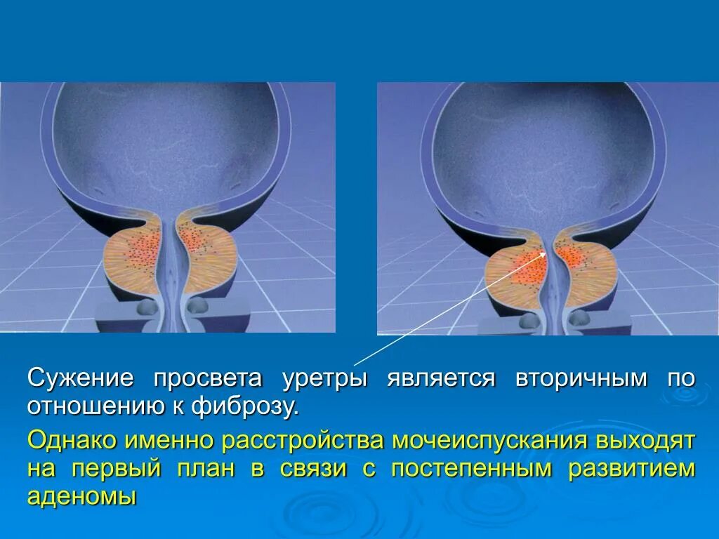 Мочеиспускание после удаления простаты. Сужение мочеиспускательного канала. Сужения мужского мочеиспускательного. Сужения мужского мочеиспускательного канала.