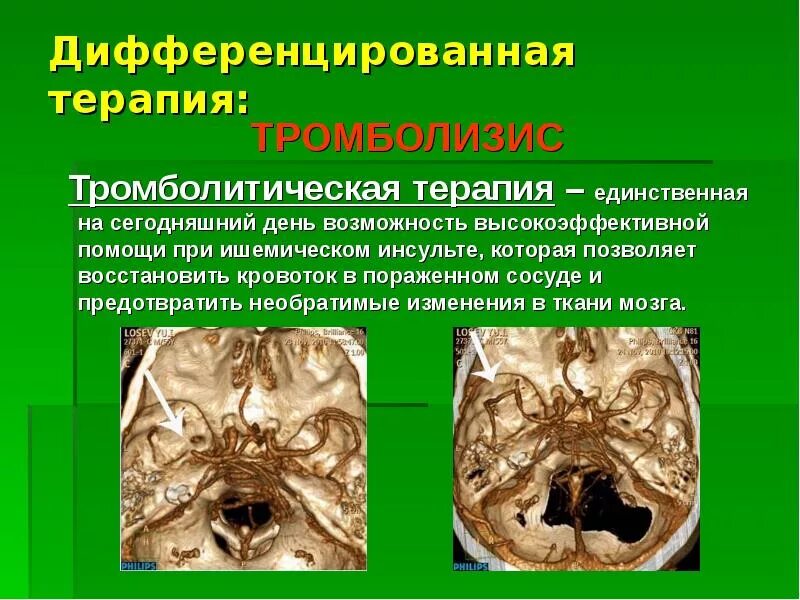 Тромболитическая терапия при инсульте. Тромболизис терапия. Тромболитическая терапия при ишемическом инсульте. Тромболизис ОНМК. Презентация на тему ишемический инсульт.