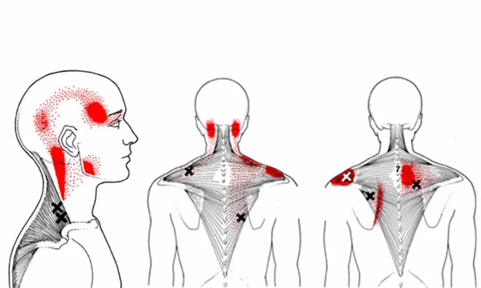 Иррадиация головной боли. Ременная мышца головы триггерные точки. Триггерные точки трапециевидной мышцы. Миофасциальный синдром триггерные точки. Миофасциальный синдром триггерные точки спины.