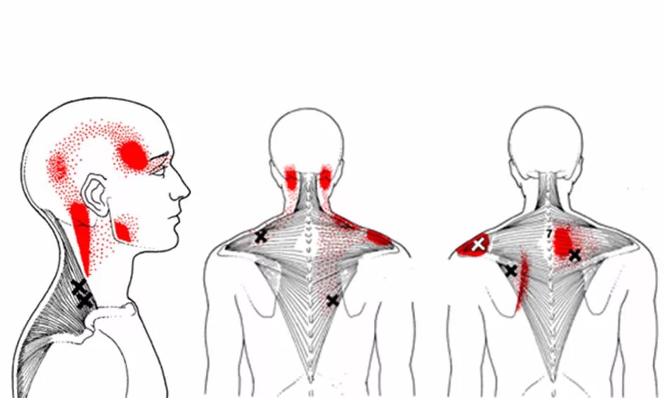 Иррадиация боли в нижнюю челюсть. Ременная мышца головы триггерные точки. Триггерные точки трапециевидной мышцы. Миофасциальный синдром триггерные точки. Миофасциальный синдром триггерные точки спины.