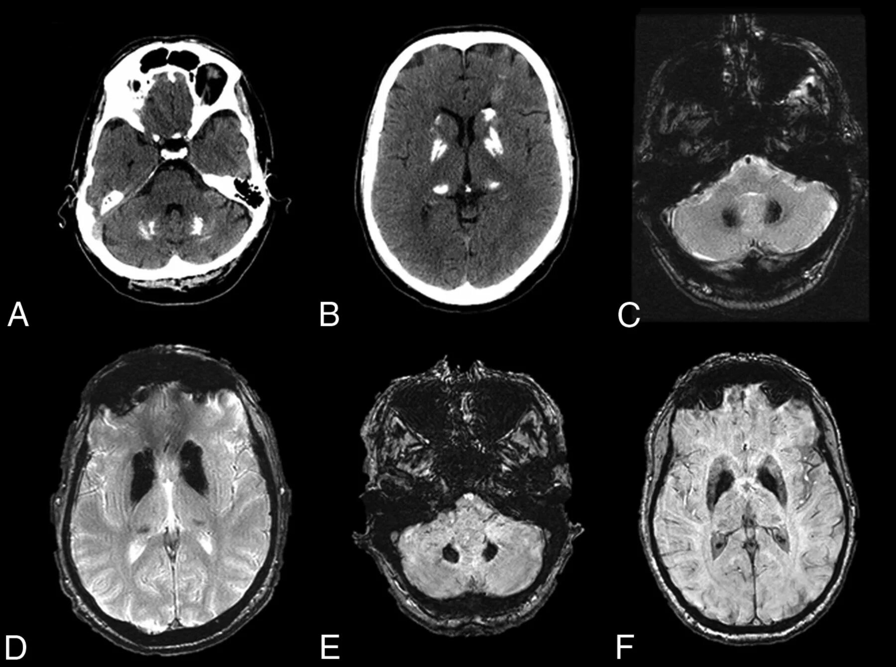 Brain 49. Кальцификация базальных ганглиев кт. Диффузная внутричерепная кальцификация. Basal ganglia calcification MRI.