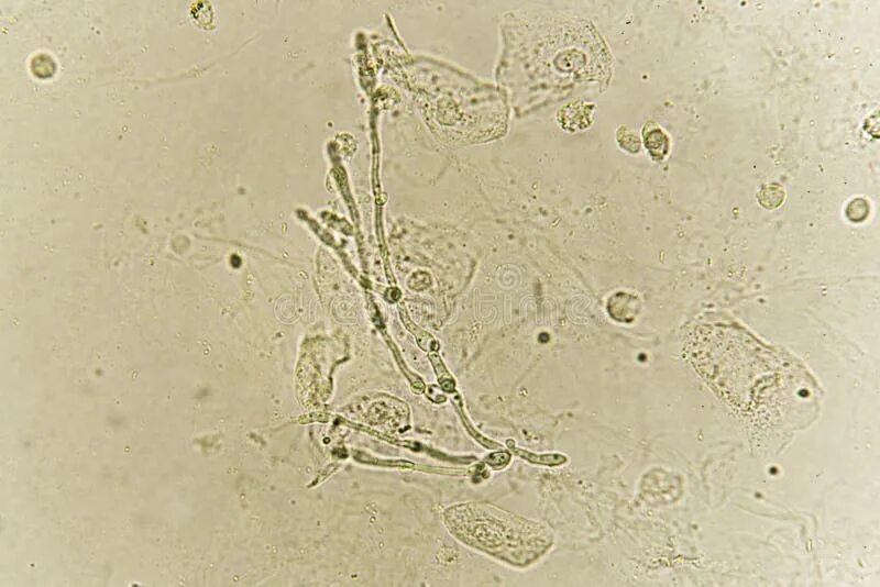 Дрожжевые клетки в моче повышены. Кандида альбиканс микроскопия. Candida albicans под микроскопом. Мицелий грибов в моче микроскопия.