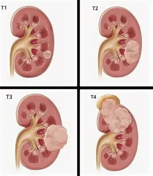 Онкология почки 1 стадия. 3 стадия рака почки