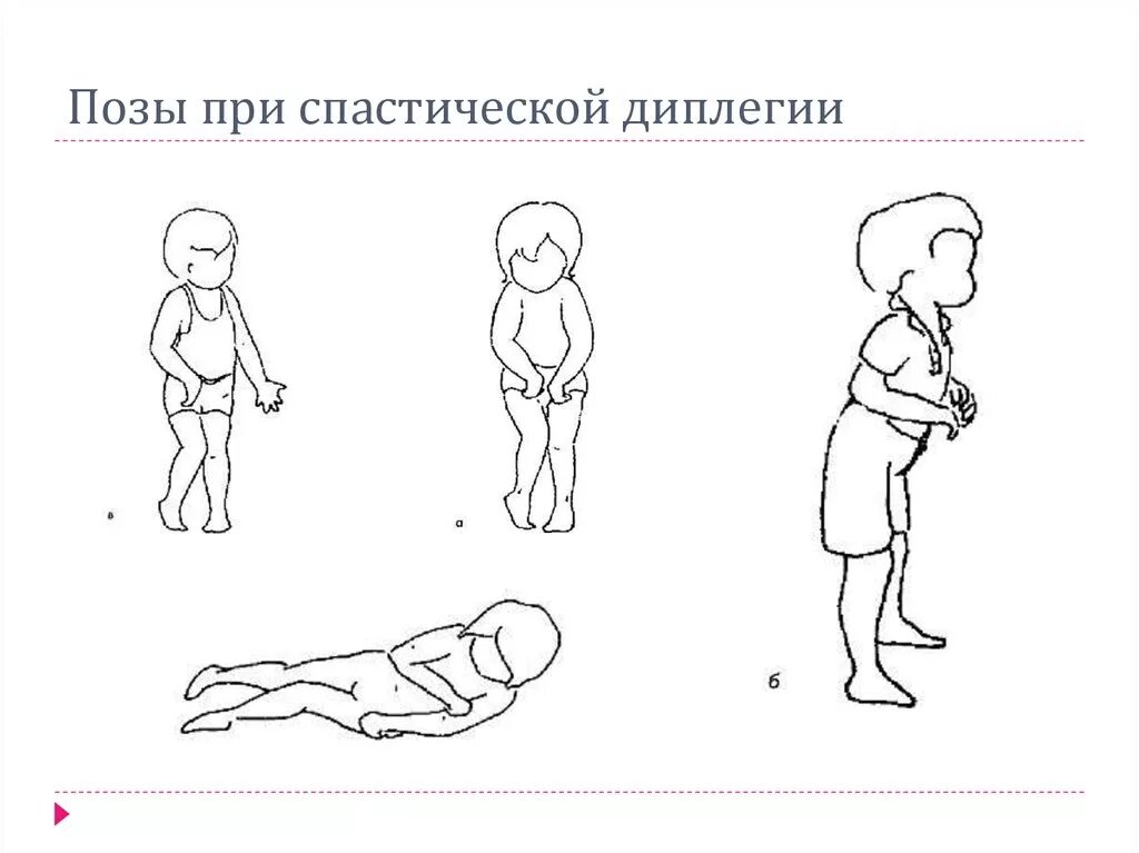 Дцп диплегия. Спастическая форма ДЦП. Спастическая диплегия форма ДЦП. Детский церебральный паралич спастическая диплегия. ДЦП спастическая диплегия синдромы.