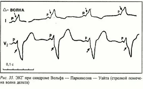 Синдром бланда уайта