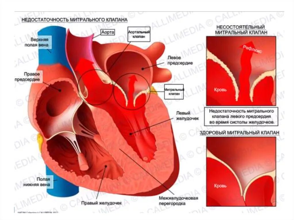 Недостаточность двустворчатого (митрального) клапана. Пороки сердца митральная недостаточность. Порок митрального клапана сердца. Сердечная недостаточность митрального клапана