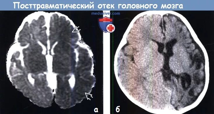 Травматический отек мозга. Вазогенный отек мозга на кт. Вазогенный отек головного мозга кт. Цитотоксический отек мозга на кт.