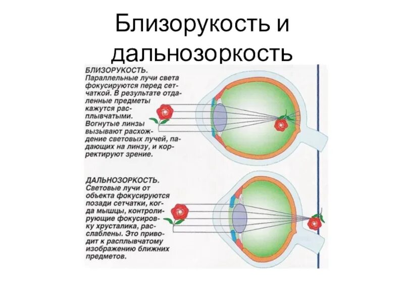 Близорукость где фокусируется изображение. При близорукости лучи света фокусируются. при близорукости свет фокусируется за сетчаткой. лучи света фокусируются перед сетчаткой. при дальнозоркости световые лучи фокусируются.