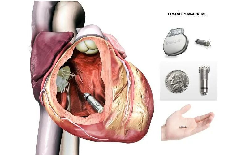 Кардиостимулятор сердца как проходит операция. Medtronic micra кардиостимулятор. кардиостимулятор сердца установленный. имплантация сердца кардиостимулятор. электрокардиостимулятор операция.