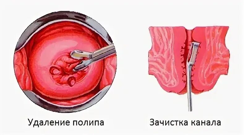 Какое время выскабливания. Полипэктомия цервикального канала. Гистероскопия полипэктомия. Полип цервикального канала кольпоскопия. Гистероскоп в цервикальном канале.