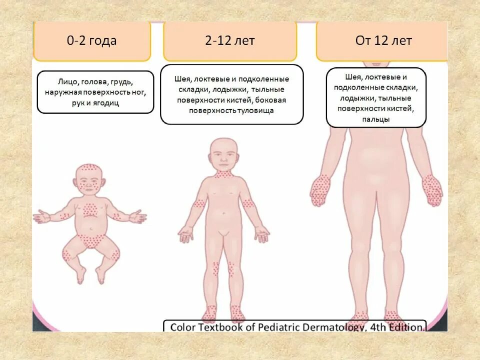 Атопический дерматит у детей атд. Атопический дерматит у детей атд