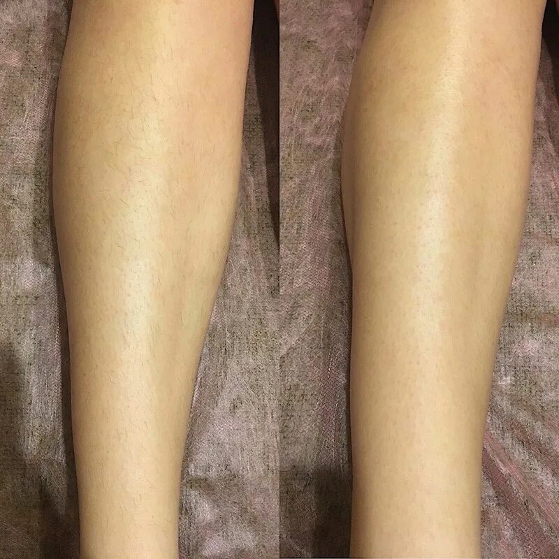 Депиляция ног до и после. Восковая эпиляция ног. Лазерная эпиляция голени до и после. После депиляции рук