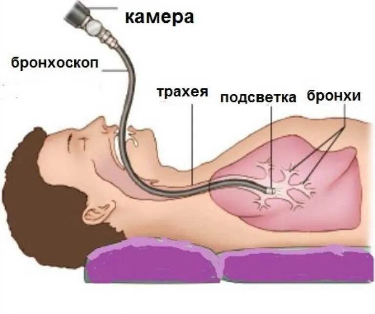 Бронхоскопия мокроты. Бронхоскопия эндоскопическое исследование бронхов. Бронхоскопия методика проведения. Бронхоскопия с промыванием.