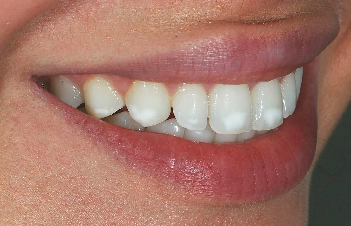 Как выглядит эмаль. 8 кг. Как выглядит эмаль. Виниры на тетрациклиновые зубы. Палитра лакра пф 115.