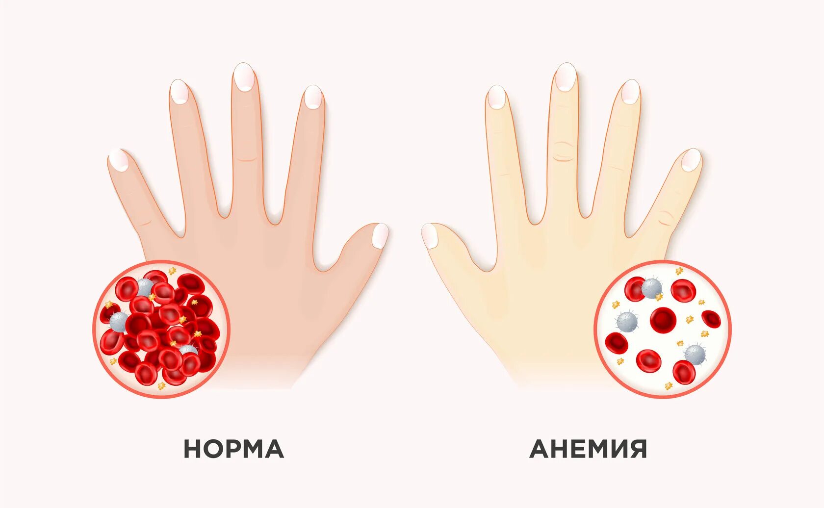 Низкий гемоглобин у мужчин причины и последствия. Анемия беременных. Стадии развития железодефицитной анемии.