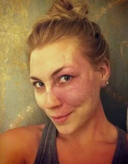Лена с пятном на лице