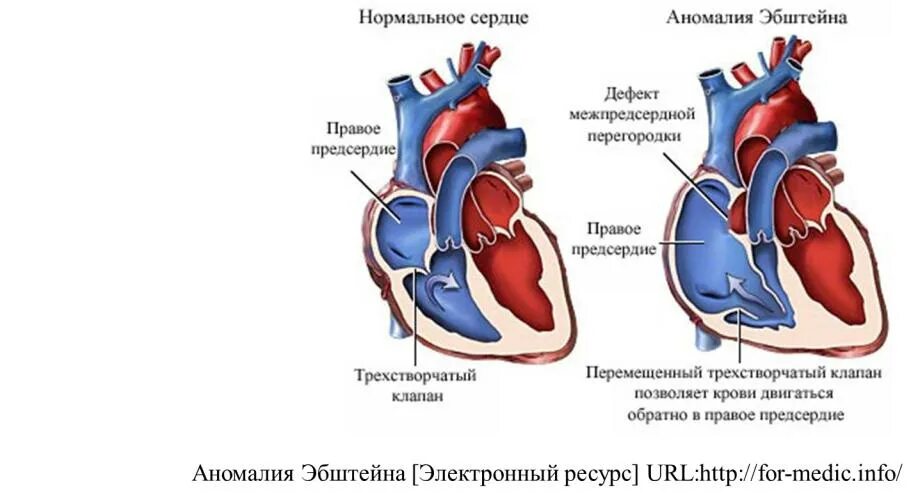 Порок сердца книги. Порок сердца книги. Врожденный порог сердца. Врожденный порок сердца тетрада фалло. А.
