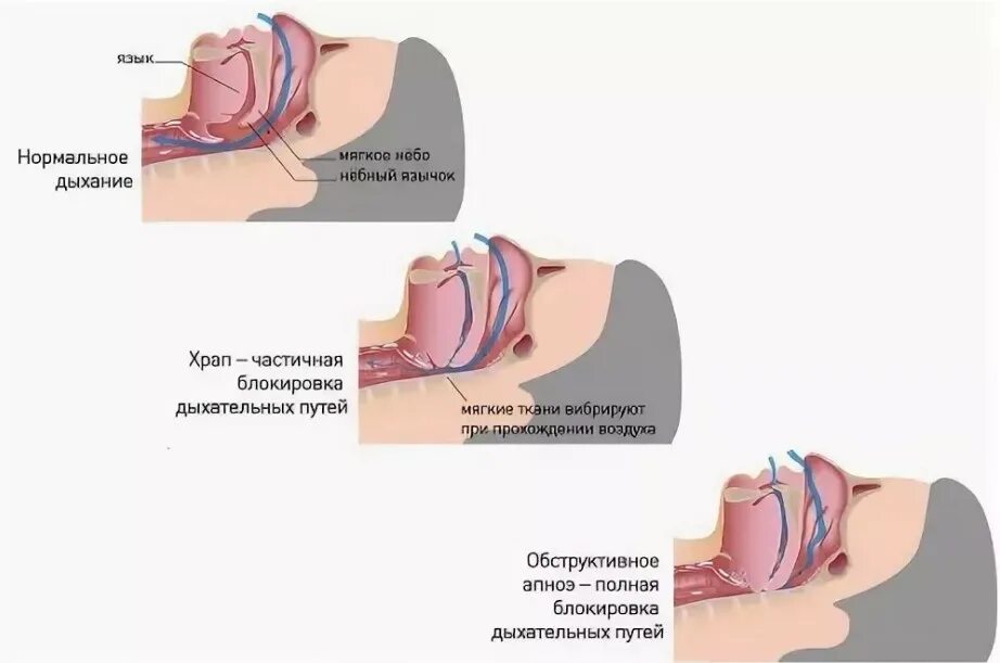 При засыпании останавливается дыхание. Храп и синдром обструктивного апноэ сна. Причины возникновения храпа. Остановка дыхания во сне. Храп механизм возникновения.