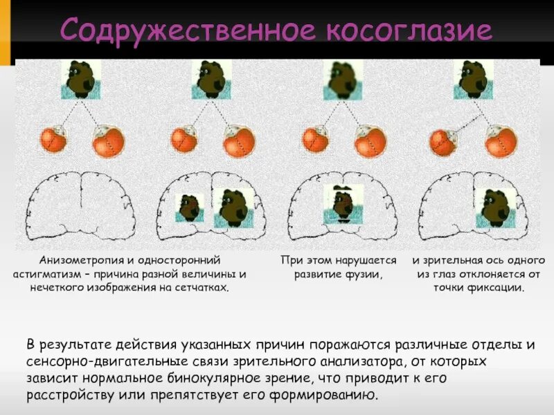 Анизометропия это в офтальмологии. Анизометропия. Гиперметропическая анизометропия. Бинокулярное зрение презентация. Осевая анизометропия.