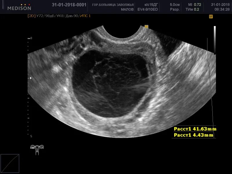 Киста яичника 44мм на 43 мм. Киста размеры для операции