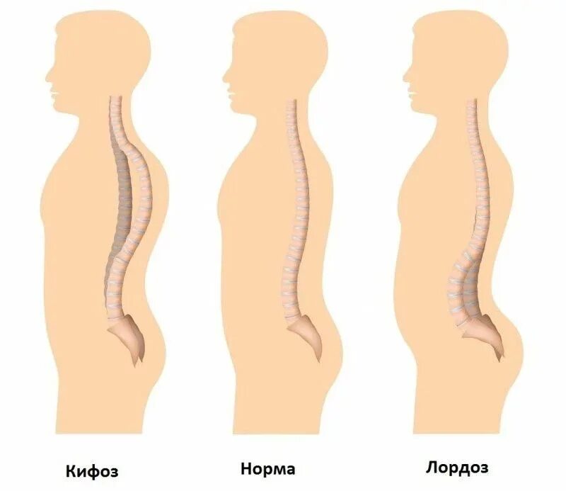 Нарушение осанки кифоз сколиоз. Искривление позвоночника гиперлордоз. Физиологический лордоз поясничного отдела. Кифоз + лордоз поясничного отдела позвоночника. Таблица лордоз кифоз сколиоз.