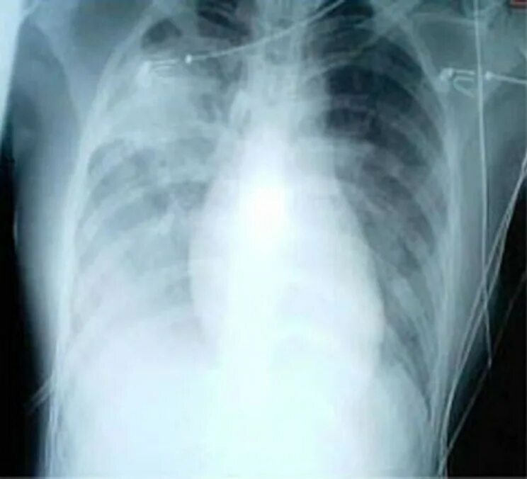 Severe acute