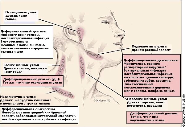 Болит горло уши и голова. Воспаление подчелюстных лимфоузлов. Надключичные лимфоузлы. Воспаленные надключичные лимфоузлы.