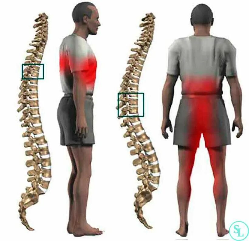 Сильно болит спина позвоночник. Радикулопатия грудного отдела позвоночника. Межпозвоночная грыжа Шморля поясничного. Бехтерева болезнь и грыжа Шморля. Протрузии грудного отдела позвоночника.