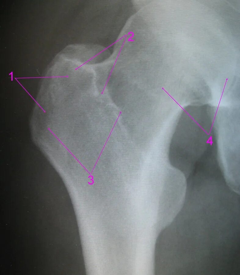 отек параартикулярных мягких тканей. суставная сумка тазобедренного сустава анатомия. трохантерита тазобедренного сустава симптомы. энтезопатия бедренной кости. энтезопатия седалищного бугра.