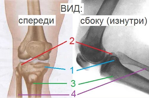 Перелом большой берцовой мыщелки. Мыщелок большеберцовой кости внутрисуставной. Перелом внутреннего мыщелка большеберцовой кости. Задний отдел медиального мыщелка большеберцовой кости. Краевой перелом медиального мыщелка бедренной кости.