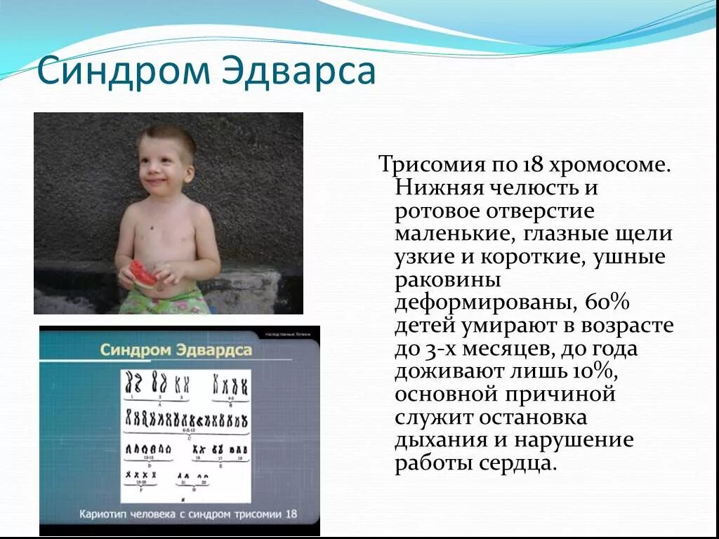 Синдром Патау трисомия по 13 хромосоме. Синдром Эдвардса (трисомия 18). Синдром Эдвардса характеристика. Синдром трисомия по х хромосоме кариотип. Болезнь с лишней хромосомой