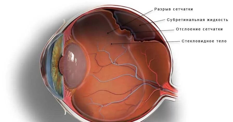 Отслойка сетчатки глаза. Тотальная отслойка сетчатки. Глазное дно отслоение сетчатки. Отслойка сетчатки зрение.