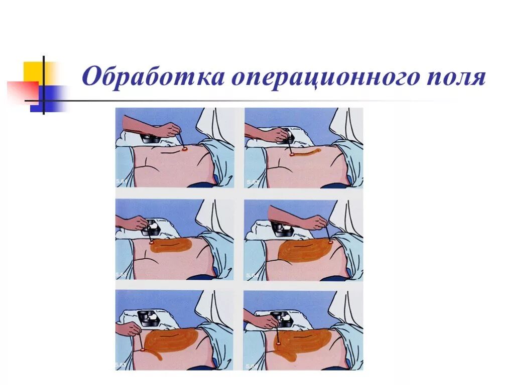 Алгоритм операционного поля. Подготовка операционного поля - обработка операционного поля. Опишите методику обработки операционного поля.. 1.      Обработка операционного поля по Гроссиху-Филончикову;. Алгоритм обработки операционного поля перед операцией.